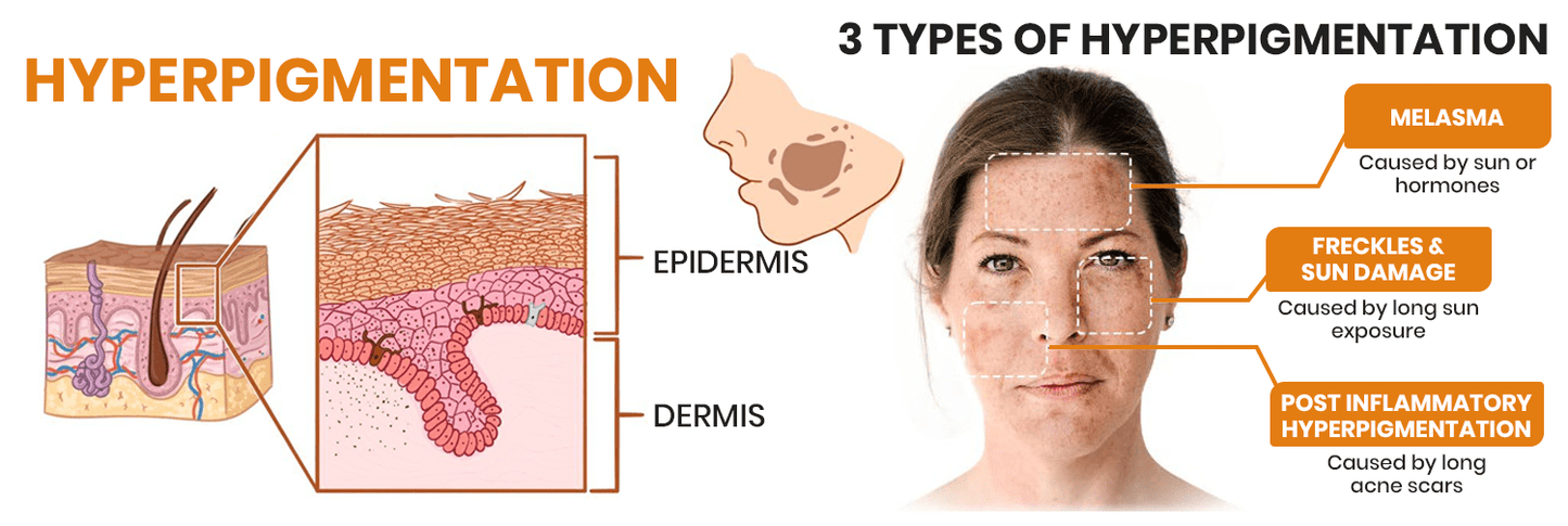 Fast Dark Spot Remover-KISSHI™ Melanin Correcting Facial Serum D02