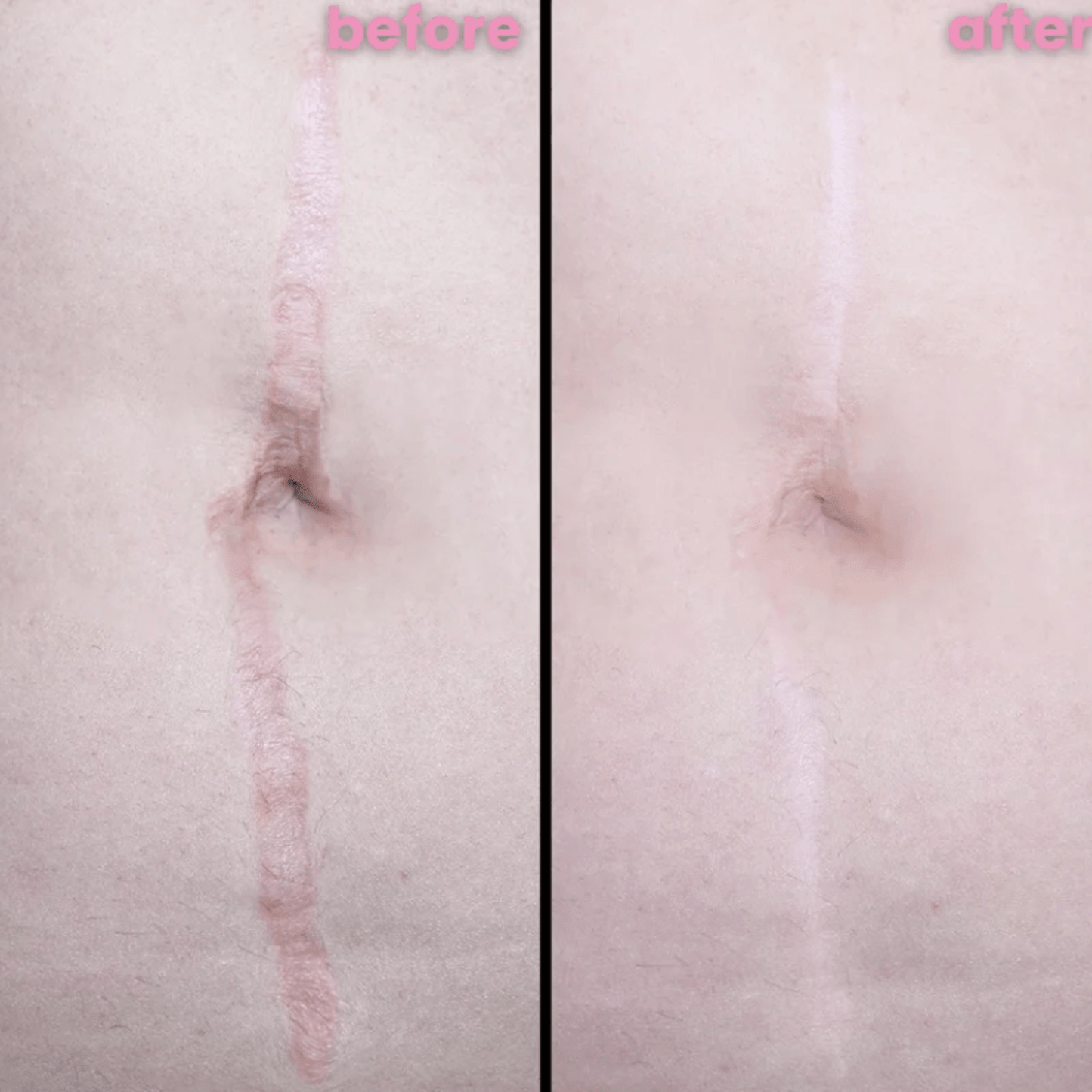 Luhaka™ Silicone Scar & Wrinkle Tape D01