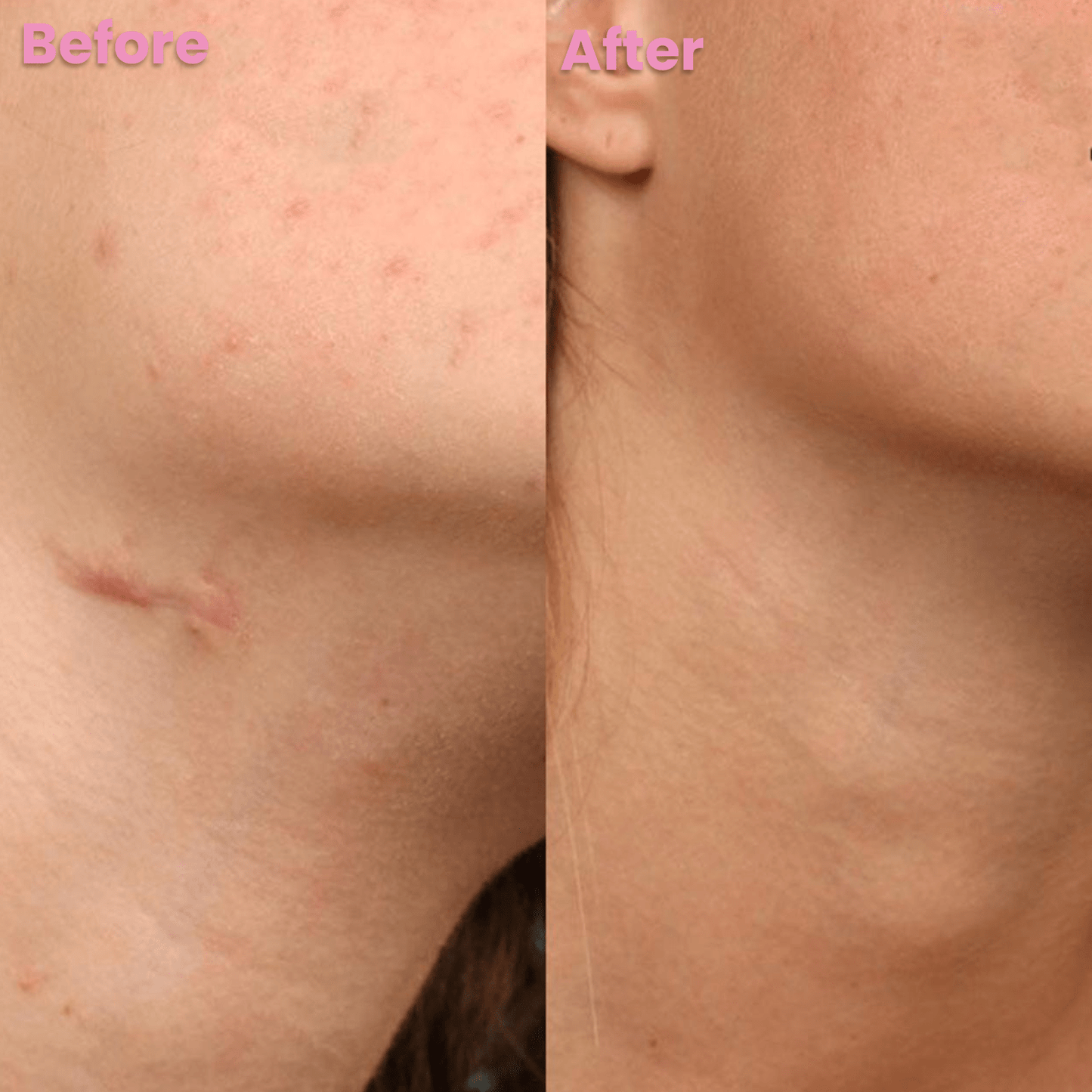 Luhaka™ Silicone Scar & Wrinkle Tape D01