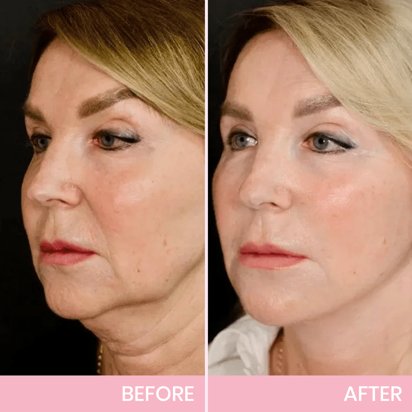 Luhaka™ V-Face Lifting Invisible Adhesive Tape D01