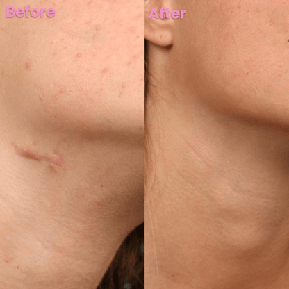 Luhaka™ Silicone Scar & Wrinkle Tape D04